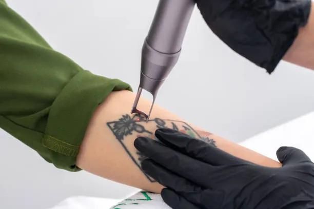 Is Laser Tattoo Removal Effective for Large Tattoos? cover picture