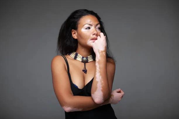 Does Vitiligo Treatment Require Multiple Sessions? cover picture