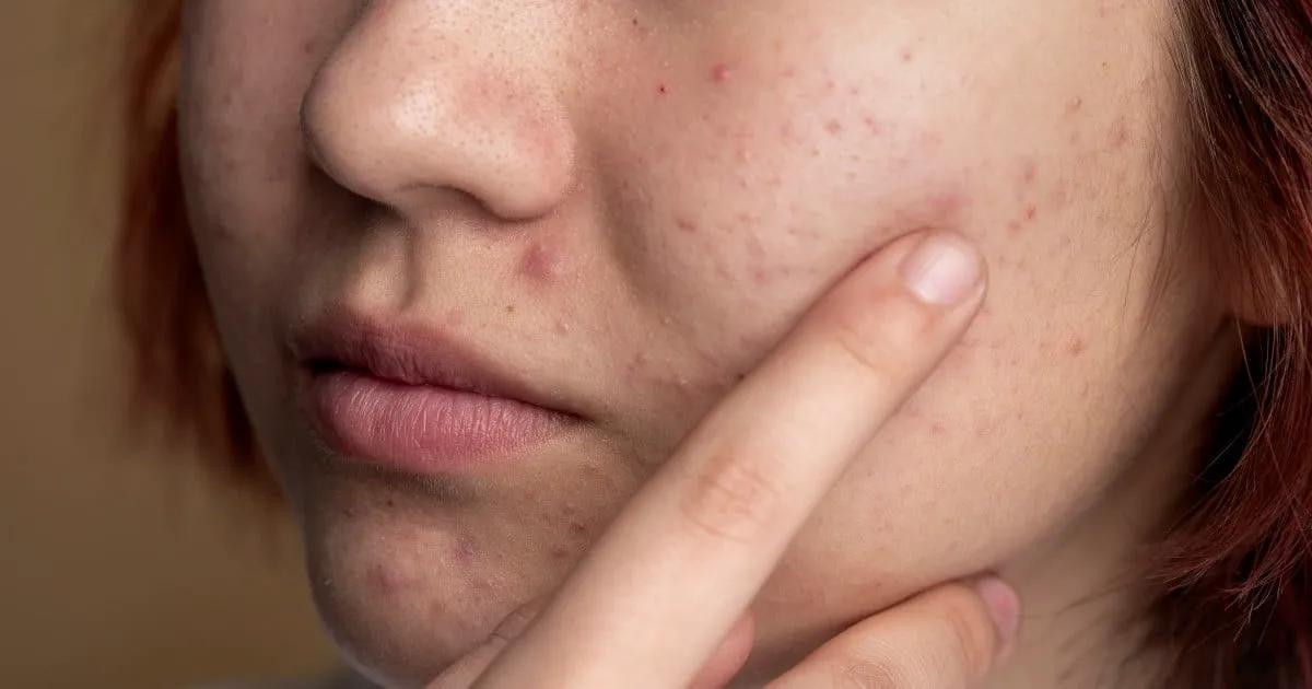 Can Acne Treatment Clear Skin Permanently? cover picture