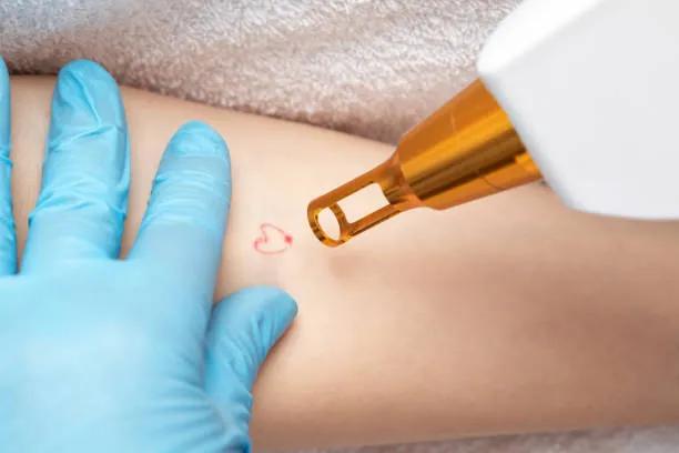 Can Laser Tattoo Removal Treat Patchy Tattoos? cover picture
