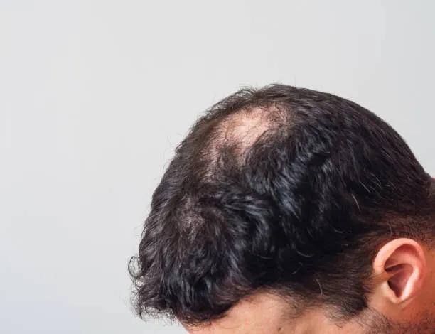 Can Hair Loss Treatment improve weak hair roots? cover picture
