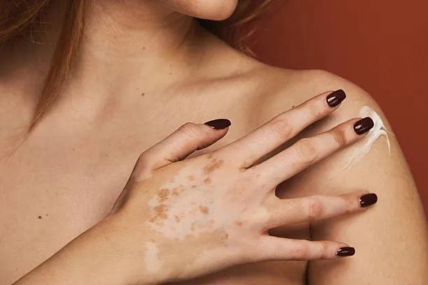 Can sensitive skin handle vitiligo treatment ? cover picture