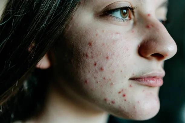 Can Acne Treatment improve skin hydration balance? cover picture