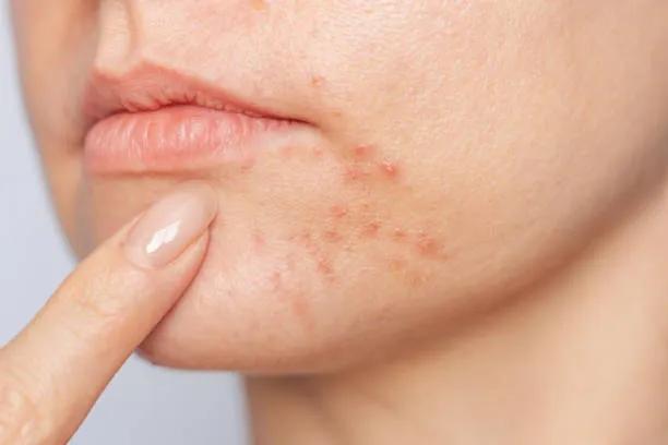 Is Laser Acne Scar Treatment Good for Deep Pores? cover picture