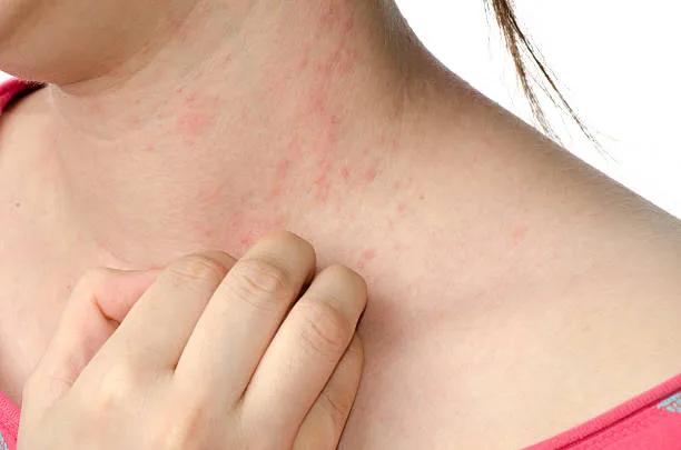 Can Eczema Treatment Minimize Skin Scarring? cover picture
