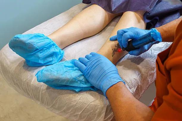 Can Tattoo Removal Help Restore Natural Skin Tone? cover picture