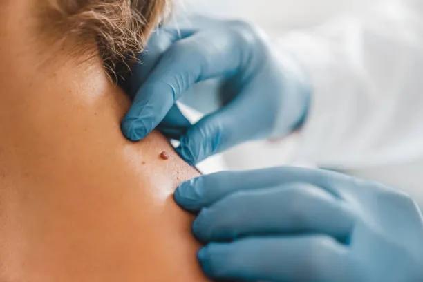 How Quickly Does Wart Removal Deliver Clear Skin? cover picture