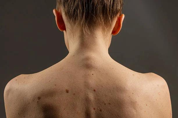 Can Skin Tag Removal Eliminate Tags in One Session? cover picture
