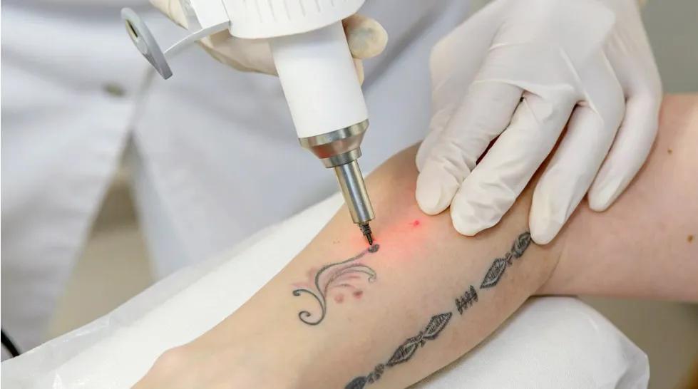 Can Laser Tattoo Removal Remove Regretful Tattoos? cover picture