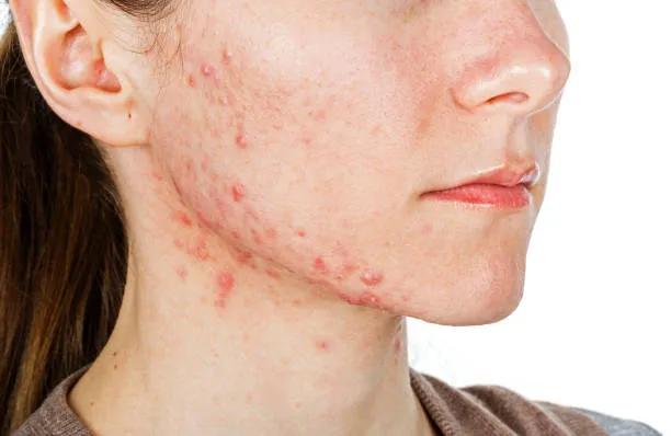 Can Acne Treatment Reduce Post-Acne Blemishes? cover picture