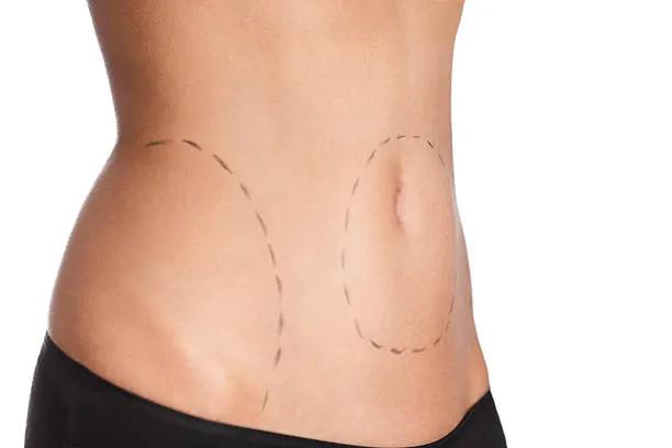 Can Tummy Tuck Help Achieve a Firmer Abdomen? cover picture