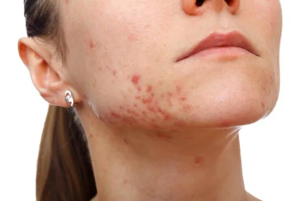 Does Acne Treatment Work for Combination Skin? cover picture