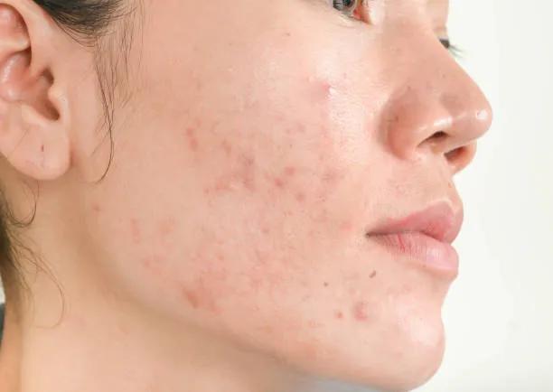 Is Laser Acne Scar Treatment a Permanent Solution? cover picture