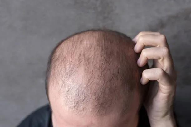 Can GFC Treatment for Hair Strengthen Weak Hair? cover picture