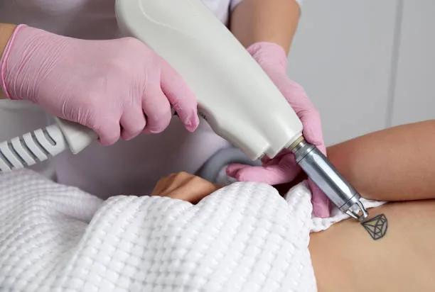 Can Laser Tattoo Removal Remove Stubborn Ink? cover picture