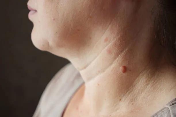 How Many Sessions Are Needed for Warts Removal Treatment ? cover picture