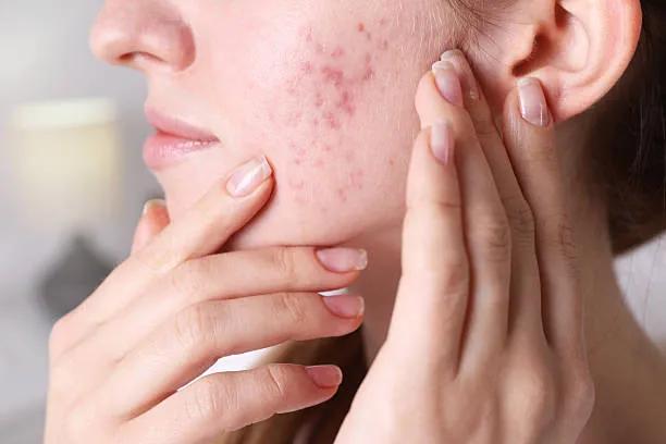 Can Laser Acne Scar Treatment Improve Skin Tone? cover picture