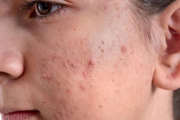 Can Laser Acne Scar Treatment Boost Skin Texture? cover picture
