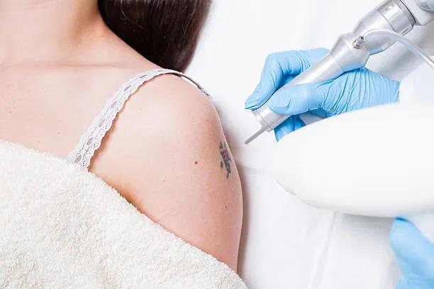 Can Laser Tattoo Removal Treat Large Tattoos Safely? cover picture
