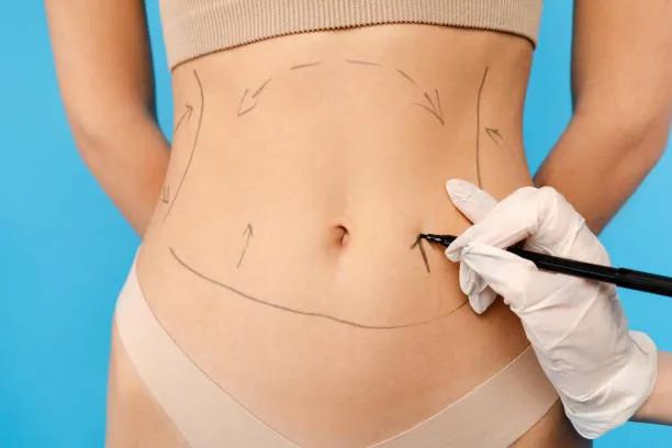 Is Mini Tummy Tuck a Permanent Solution? cover picture