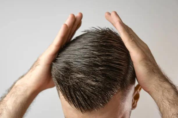 Is Hair Transplant Effective for Crown Baldness? cover picture