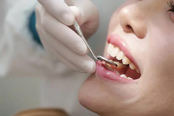 How Long Does Full Mouth Rehabilitation Take? cover picture