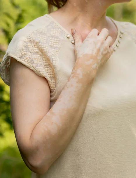 Does Vitiligo Treatment Require Multiple Sessions? cover picture