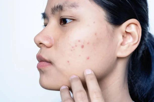 Can Laser Acne Scar Treatment Restore Skin? cover picture
