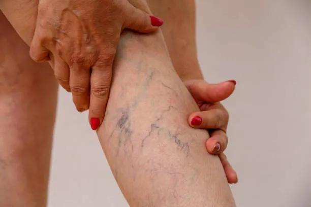 Can Spider Veins Treatment Treat Small Veins? cover picture