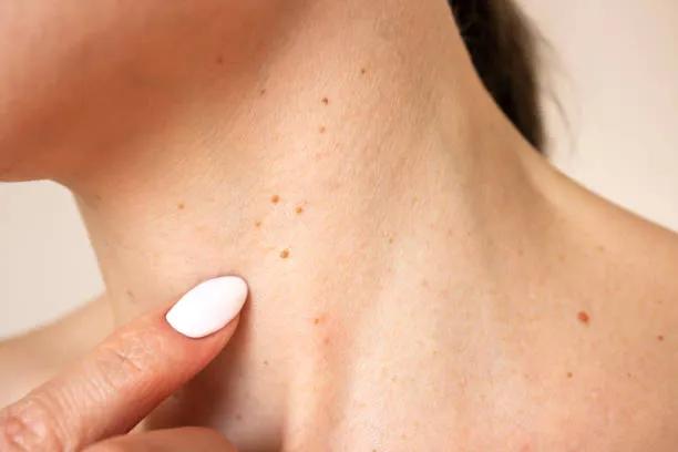 Can Enfield Royal Clinic Remove Skin Tags Safely? cover picture