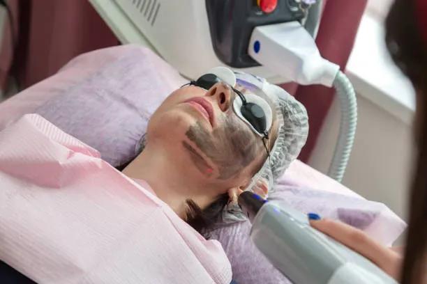 Can Laser Carbon Peeling Improve Skin Clarity? cover picture