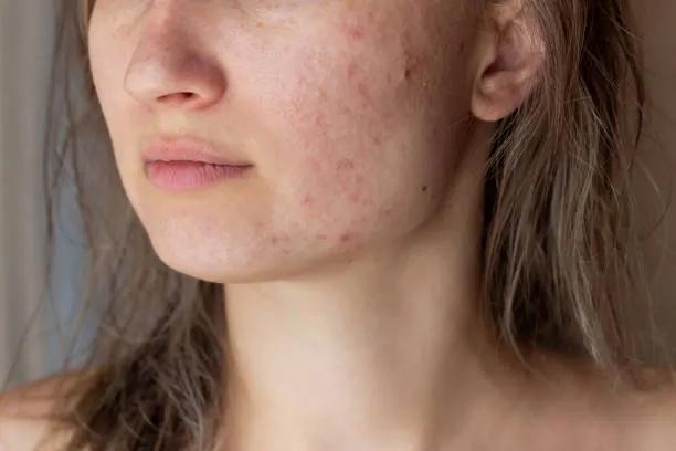 Is Laser Acne Scar Treatment Suitable for Sensitive Skin? cover picture