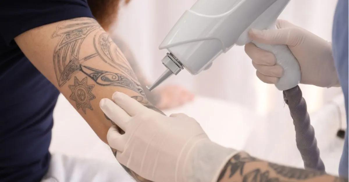 Can Laser Tattoo Removal Treat Multicolor Ink? cover picture
