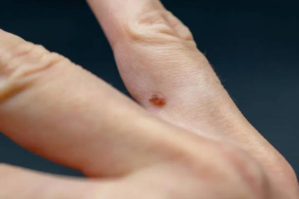 How Does Warts Removal Treatment Remove Stubborn Growths? cover picture