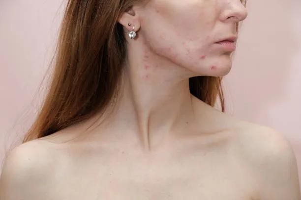 How Does Laser Acne Scar Treatment Restore Skin Texture? cover picture
