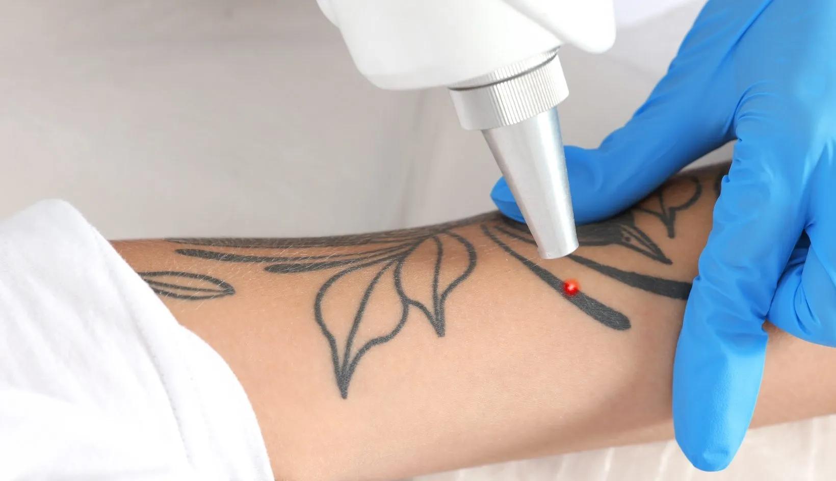 Is Laser Tattoo Removal Effective for Uneven Tattoo Ink? cover picture