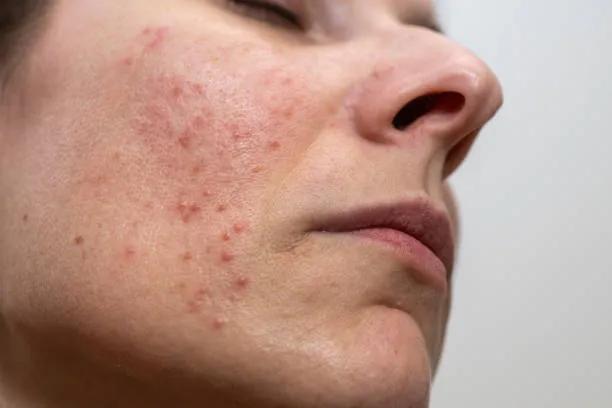 Can Acne Treatment Help Improve Overall Skin Clarity? cover picture