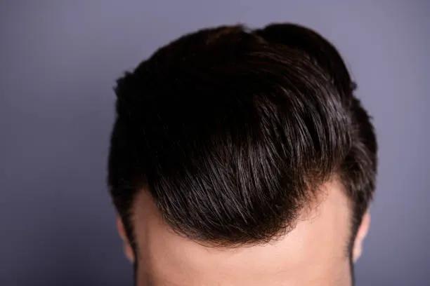 Can Hair Transplant Improve a Thin Crown Area? cover picture