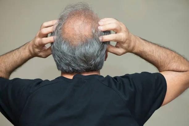 Is GFC Treatment for Hair Worth Considering for Hair Loss? cover picture