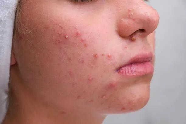 Can Acne Treatment Help Manage Persistent Pimples? cover picture
