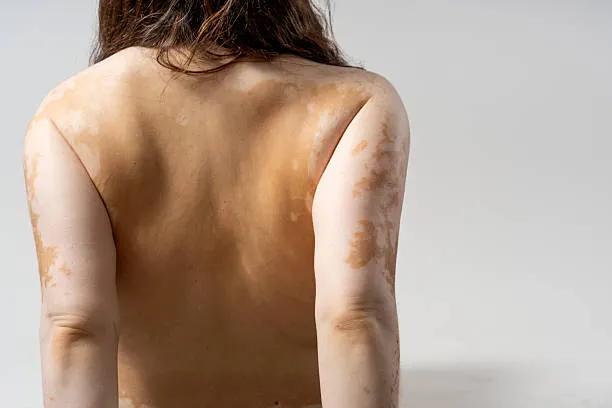 Can Vitiligo Treatment Address Stubborn White Patches? cover picture