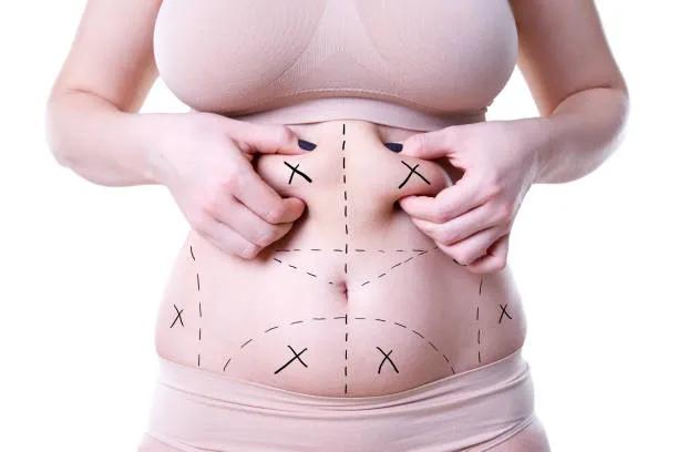 Can Mini Tummy Tuck Address Abdominal Skin Changes? cover picture