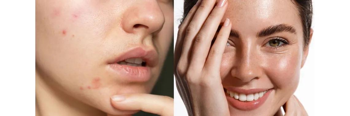 Anti-Acne Cosmetics Market Future Growth Analysis and Forecast Till 2034 cover picture