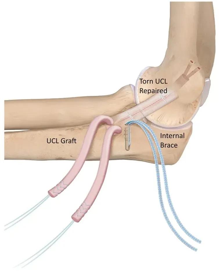 Cold Therapy Wraps and Elbow Injury Recovery: What to Know cover picture