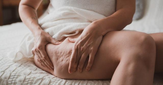 What Is Cellulite, and What Can You Do About It? cover picture