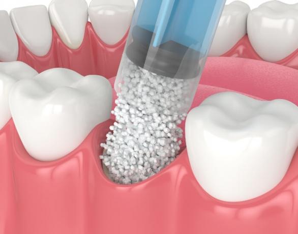 Everything You Should Know About Bone Grafting Before Dental Implants cover picture