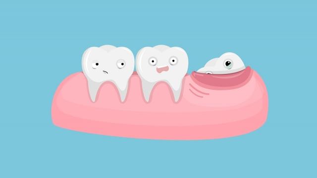 Choosing Right Dentist for Wisdom Teeth Removal in Houston cover picture