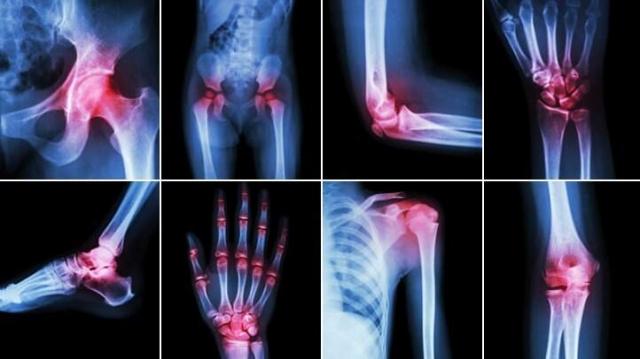 Everything You Should Know About Joint Supplements cover picture