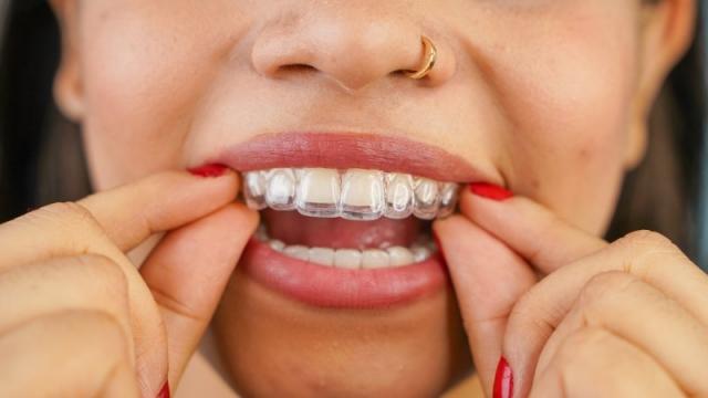 Metal Braces vs. Clear Aligners: Which One is Right for You? cover picture