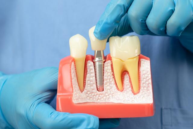 Teeth Implants Explained: Your Guide to a Stable Smile cover picture